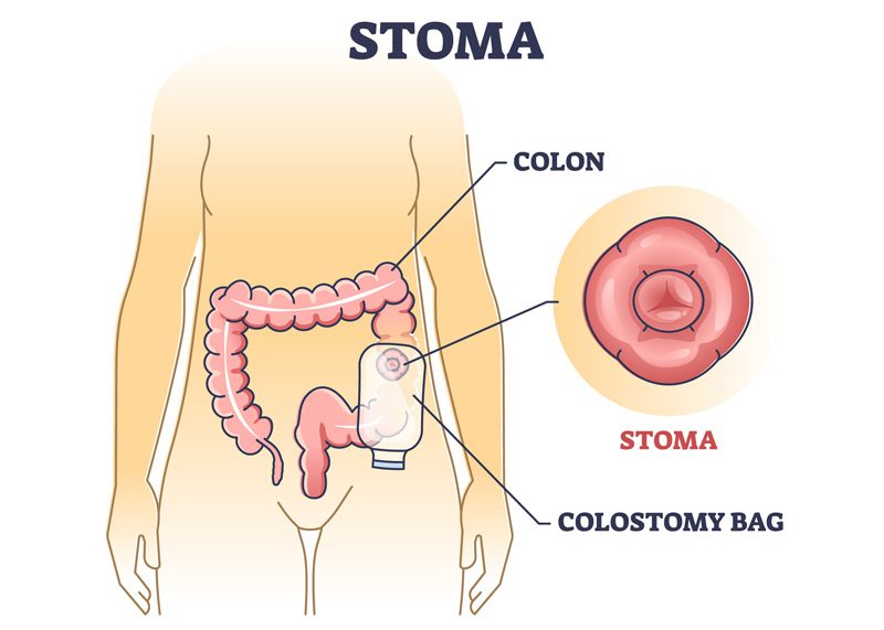 Illustration-of-a-stoma-bag-after-colon-surgery
